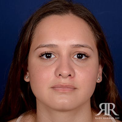 Ethnic Rhinoplasty Before & After Gallery - Patient 139587 - Image 2