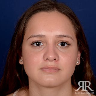 Ethnic Rhinoplasty Before & After Gallery - Patient 139587 - Image 2