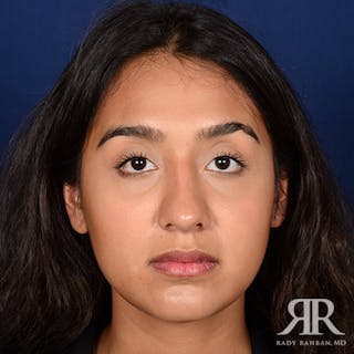 Female Rhinoplasty Before & After Gallery - Patient 207121 - Image 2