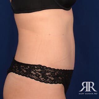 Severe Diastasis Recti Before & After Gallery - Patient 414518 - Image 6