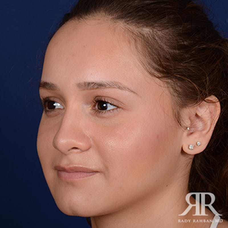 Ethnic Rhinoplasty Before & After Gallery - Patient 139587 - Image 3