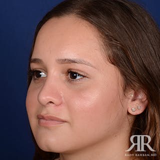 Ethnic Rhinoplasty Before & After Gallery - Patient 139587 - Image 4