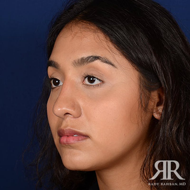 Female Rhinoplasty Before & After Gallery - Patient 207121 - Image 4