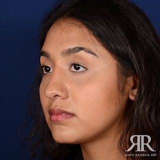 Female Rhinoplasty Before & After Gallery - Patient 207121 - Image 4