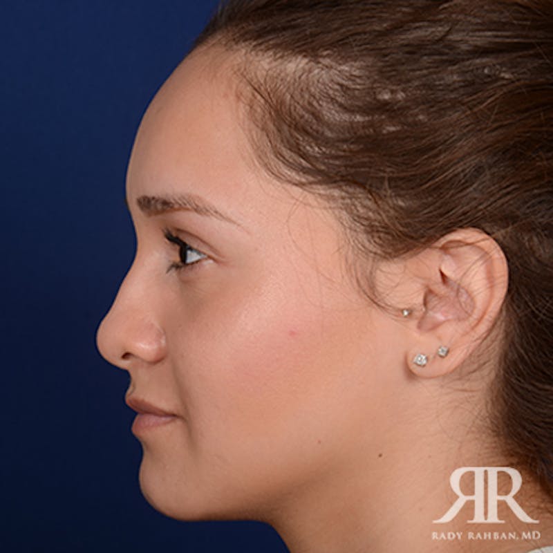 Ethnic Rhinoplasty Before & After Gallery - Patient 139587 - Image 5