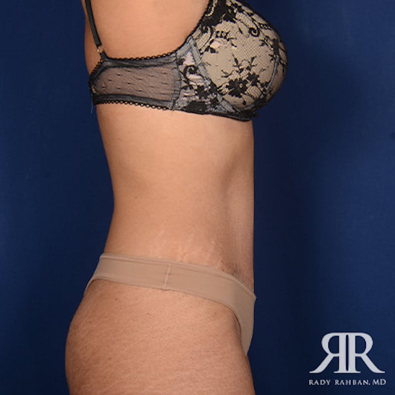 Tummy Tuck Before & After Gallery - Patient 428491 - Image 6