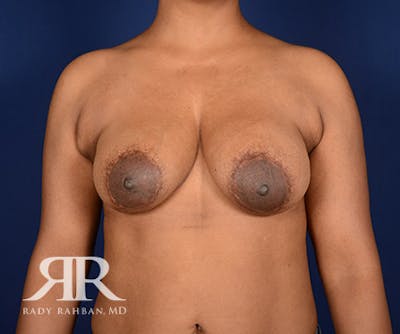 Corrective Breast Surgery Before & After Gallery - Patient 245673 - Image 1