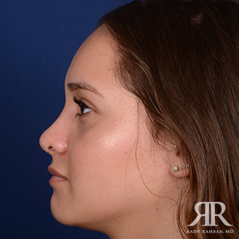 Ethnic Rhinoplasty Before & After Gallery - Patient 139587 - Image 6