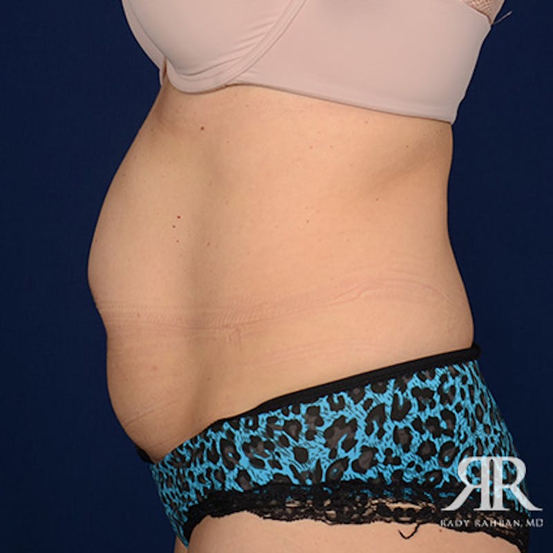 Severe Diastasis Recti Before & After Gallery - Patient 229924 - Image 5