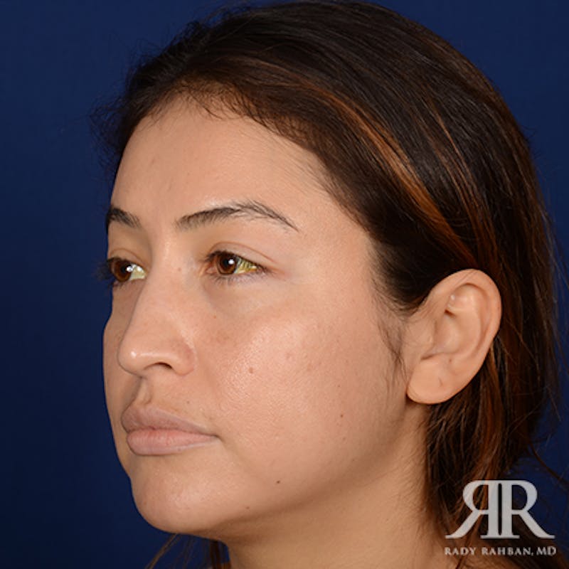 Ethnic Rhinoplasty Before & After Gallery - Patient 313095 - Image 3