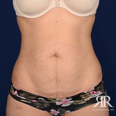 Severe Diastasis Recti Before & After Gallery - Patient 243856 - Image 1