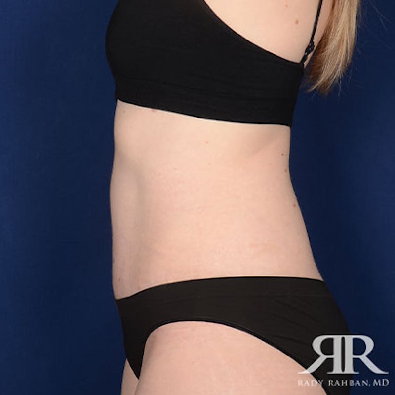 Tummy Tuck Before & After Gallery - Patient 367628 - Image 6