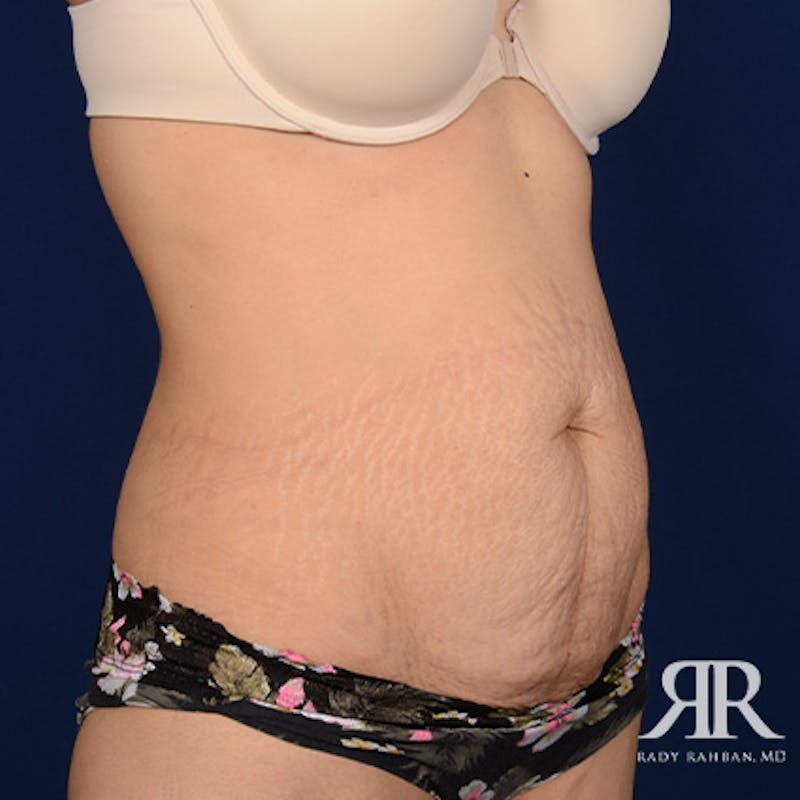 Severe Diastasis Recti Before & After Gallery - Patient 243856 - Image 3