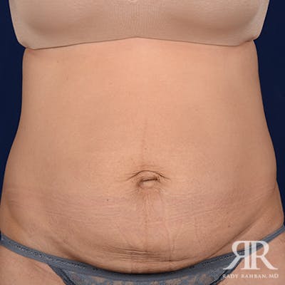 Tummy Tuck Before & After Gallery - Patient 103436 - Image 1