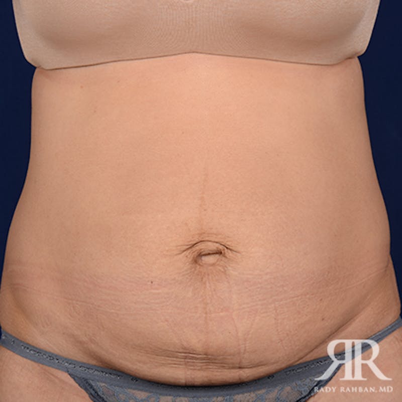 Tummy Tuck Before & After Gallery - Patient 103436 - Image 1