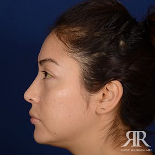 Ethnic Rhinoplasty Before & After Gallery - Patient 313095 - Image 6