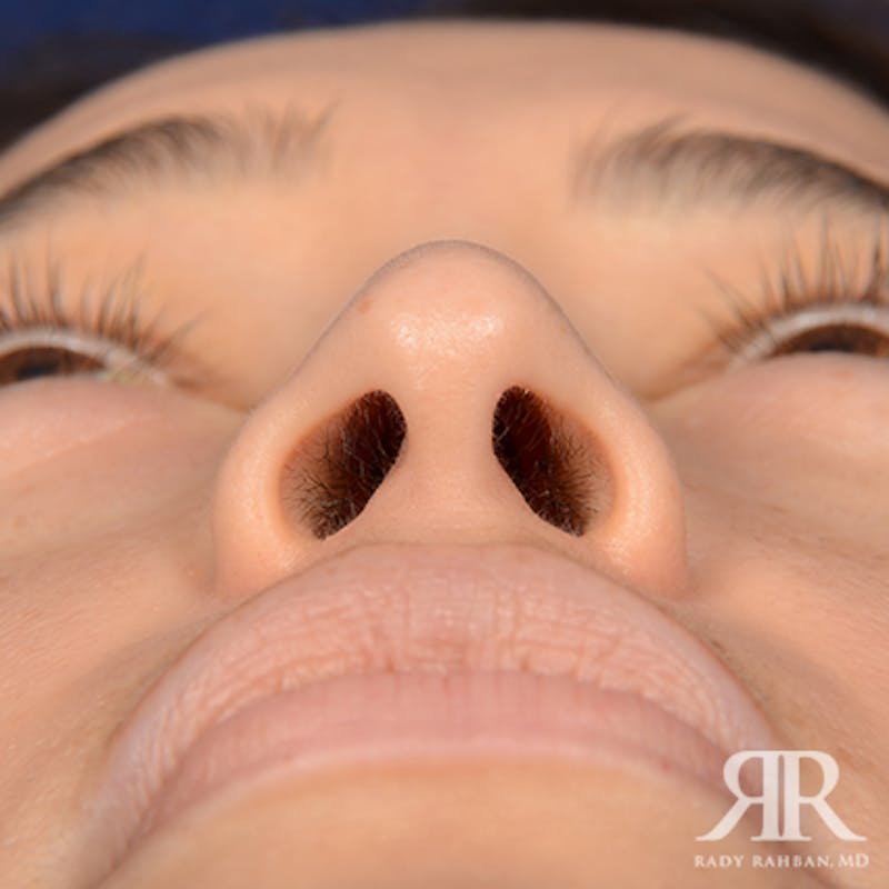 Ethnic Rhinoplasty Before & After Gallery - Patient 313095 - Image 7