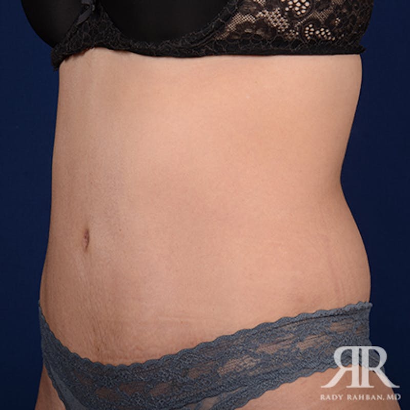 Tummy Tuck Before & After Gallery - Patient 103436 - Image 4