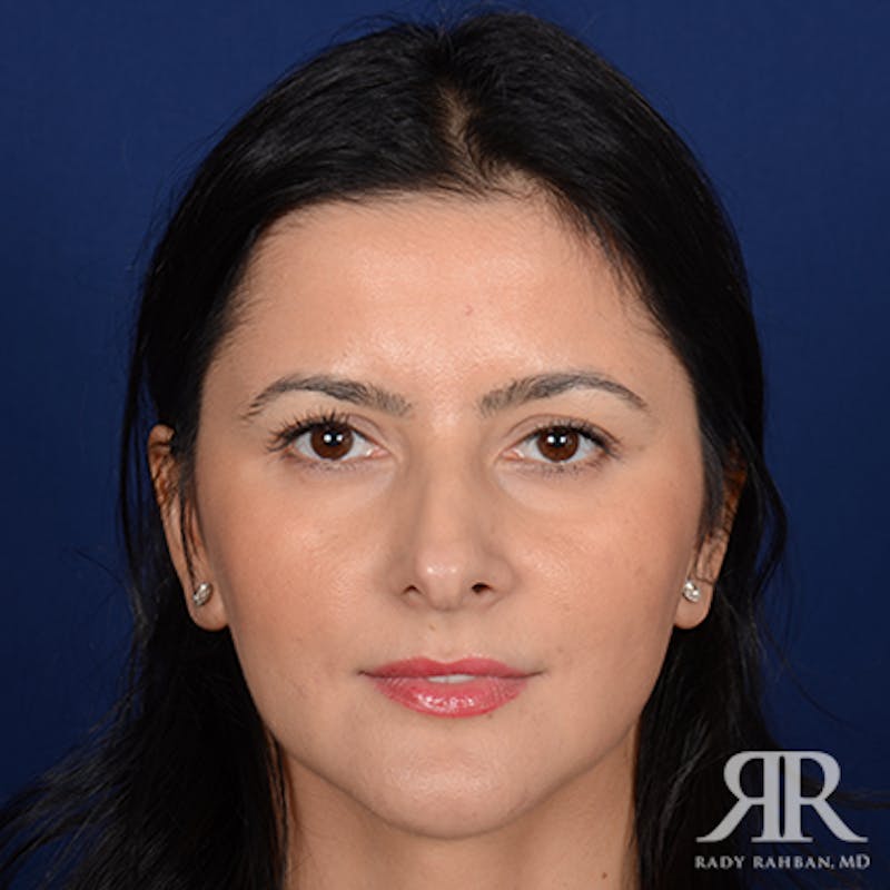 Ethnic Rhinoplasty Before & After Gallery - Patient 198924 - Image 1