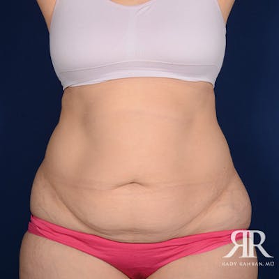 Severe Diastasis Recti Before & After Gallery - Patient 147122 - Image 1