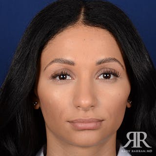 Female Rhinoplasty Before & After Gallery - Patient 289625 - Image 2