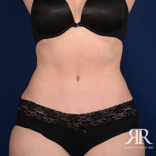 Severe Diastasis Recti Before & After Gallery - Patient 147122 - Image 2