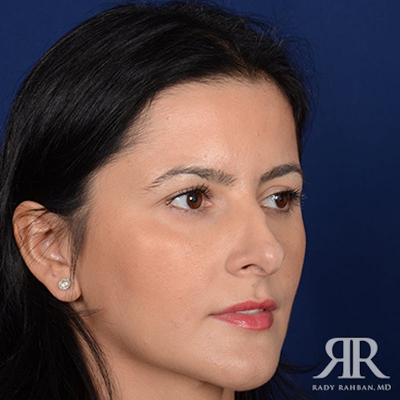 Ethnic Rhinoplasty Before & After Gallery - Patient 198924 - Image 3