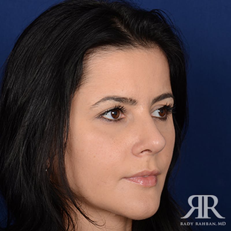 Ethnic Rhinoplasty Before & After Gallery - Patient 198924 - Image 4