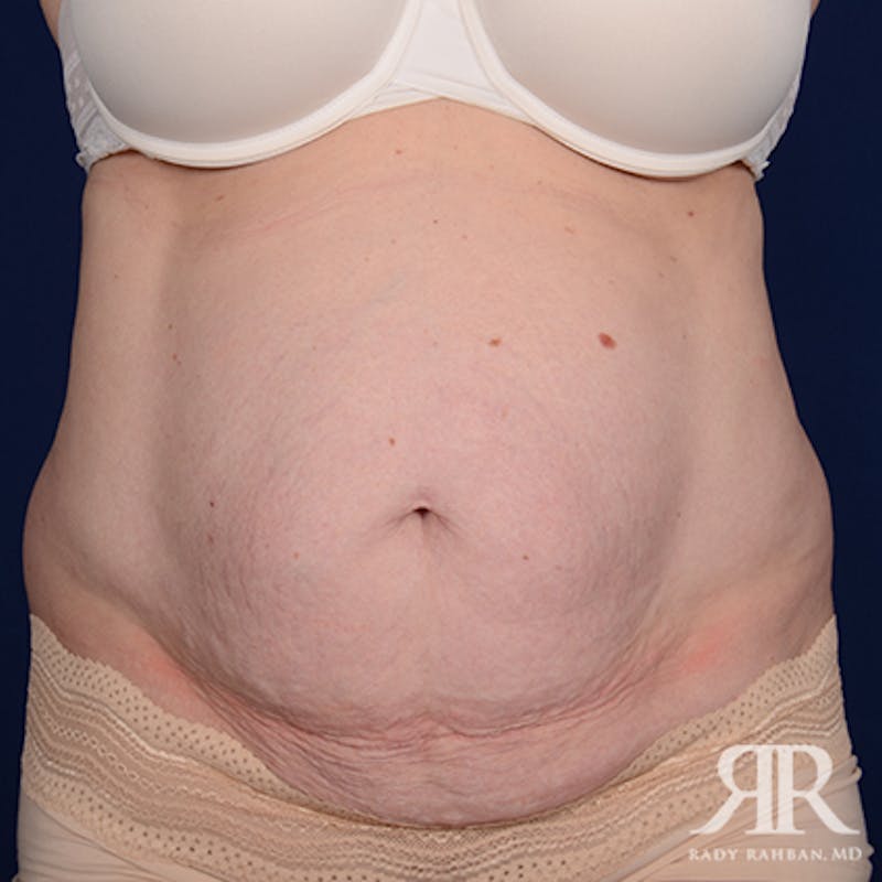 Tummy Tuck Before & After Gallery - Patient 331008 - Image 1