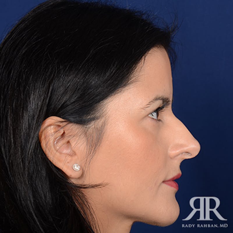 Ethnic Rhinoplasty Before & After Gallery - Patient 198924 - Image 5