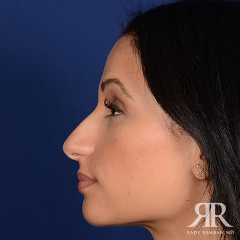 Female Rhinoplasty Before & After Gallery - Patient 289625 - Image 5
