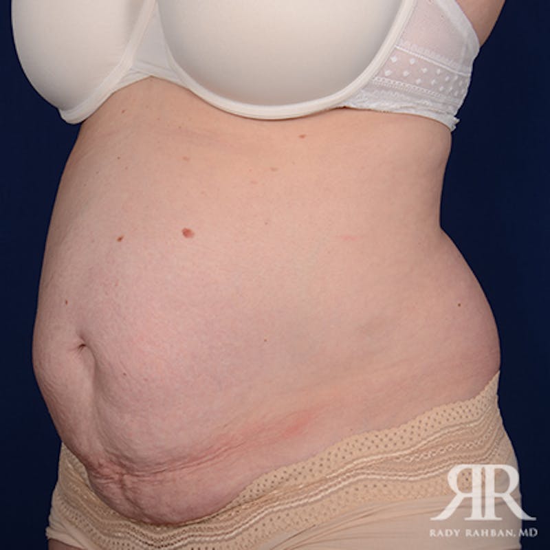 Tummy Tuck Before & After Gallery - Patient 331008 - Image 3