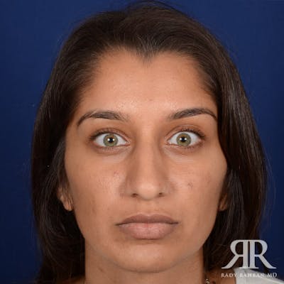 Ethnic Rhinoplasty Before & After Gallery - Patient 384218 - Image 1