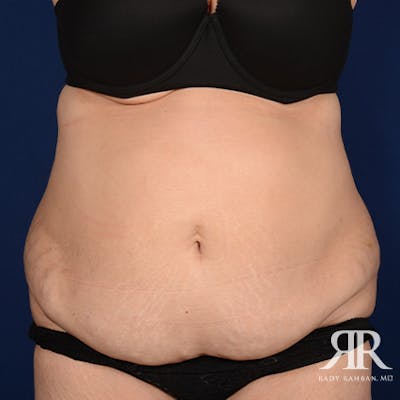 Severe Diastasis Recti Before & After Gallery - Patient 130593 - Image 1