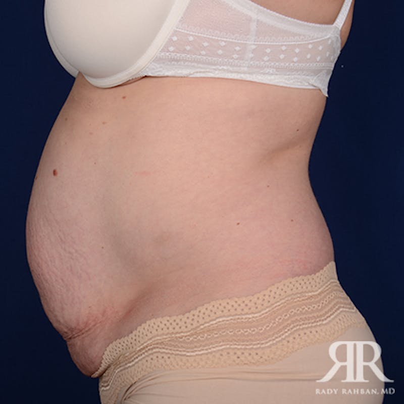 Tummy Tuck Before & After Gallery - Patient 331008 - Image 5