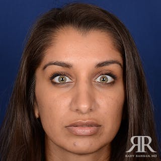 Ethnic Rhinoplasty Before & After Gallery - Patient 384218 - Image 2