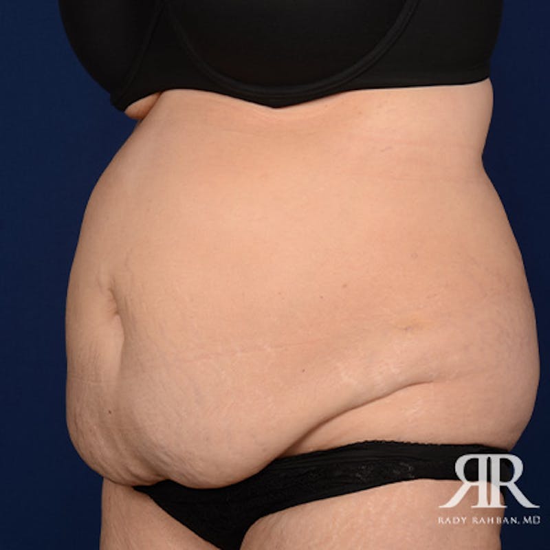 Severe Diastasis Recti Before & After Gallery - Patient 130593 - Image 3