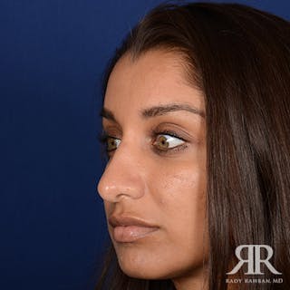 Ethnic Rhinoplasty Before & After Gallery - Patient 384218 - Image 4