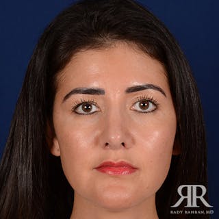 Female Rhinoplasty Before & After Gallery - Patient 177567 - Image 2