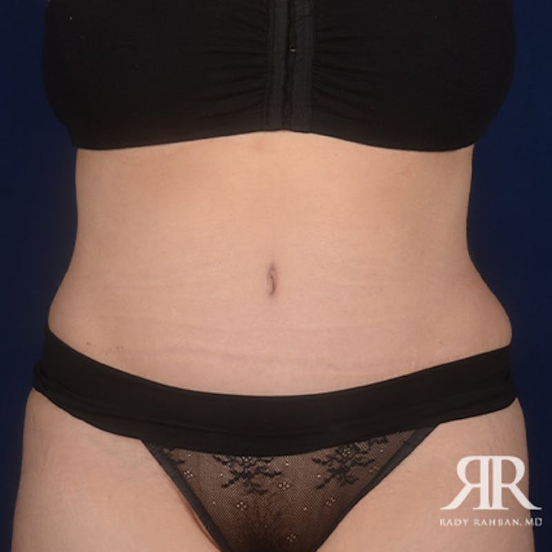 Tummy Tuck Before & After Gallery - Patient 253042 - Image 2