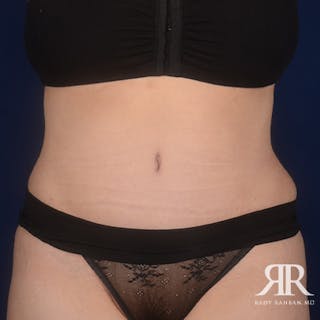 Tummy Tuck Before & After Gallery - Patient 253042 - Image 2