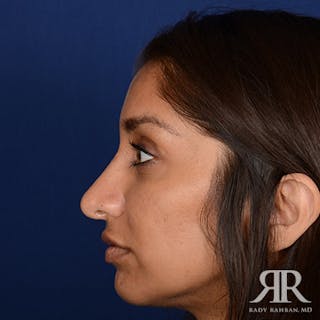 Ethnic Rhinoplasty Before & After Gallery - Patient 384218 - Image 6