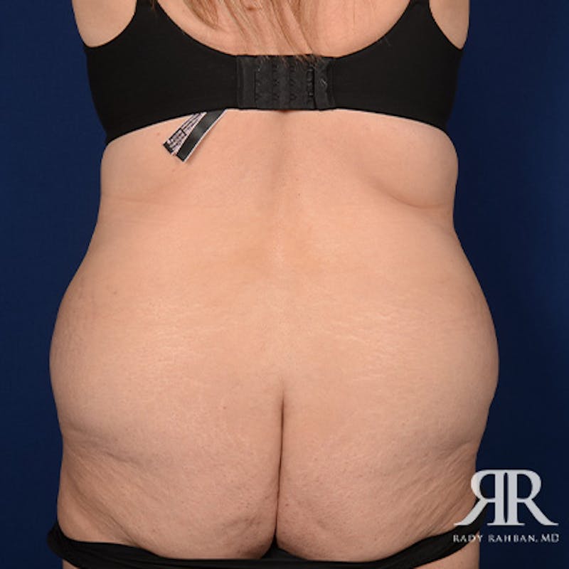 Severe Diastasis Recti Before & After Gallery - Patient 130593 - Image 7