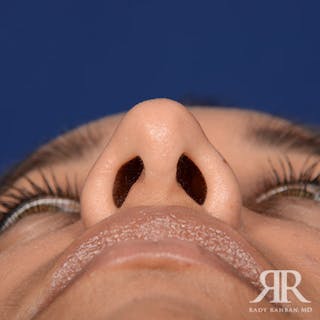 Ethnic Rhinoplasty Before & After Gallery - Patient 384218 - Image 8