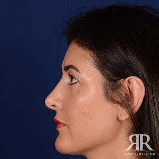 Female Rhinoplasty Before & After Gallery - Patient 177567 - Image 6