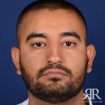 Ethnic Rhinoplasty Before & After Gallery - Patient 383855 - Image 1
