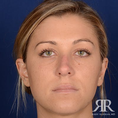 Female Rhinoplasty Before & After Gallery - Patient 205122 - Image 1
