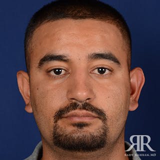 Ethnic Rhinoplasty Before & After Gallery - Patient 383855 - Image 2