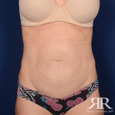 Severe Diastasis Recti Before & After Gallery - Patient 272204 - Image 1