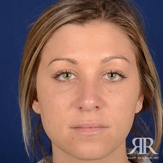 Female Rhinoplasty Before & After Gallery - Patient 205122 - Image 2